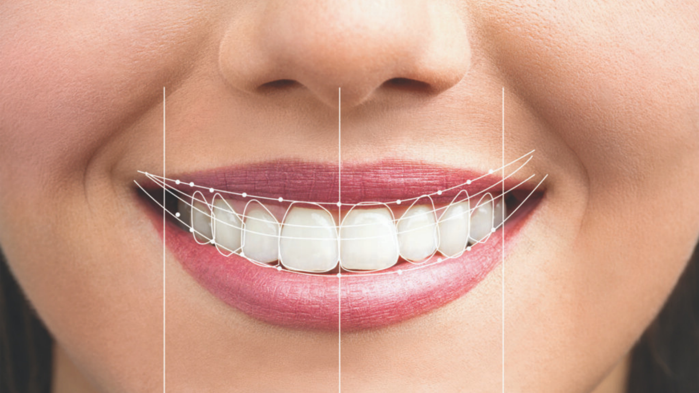 gülüş tasarımı | smile design