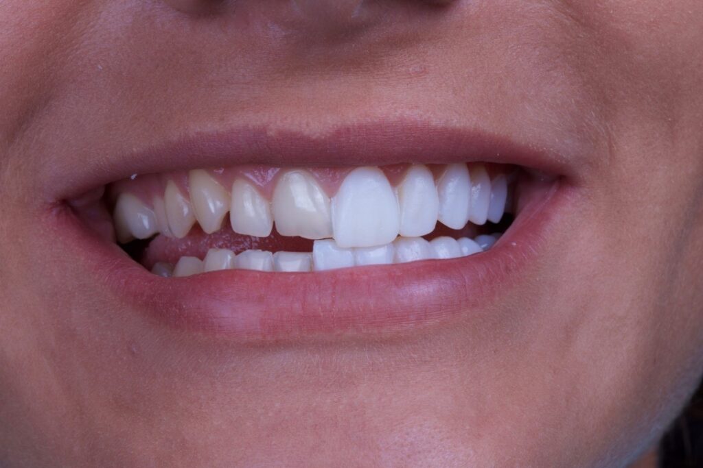 dental veneers | зубные виниры